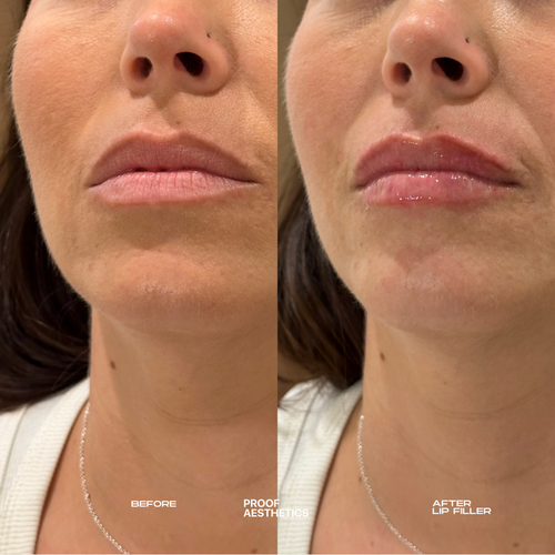 Lip Filler