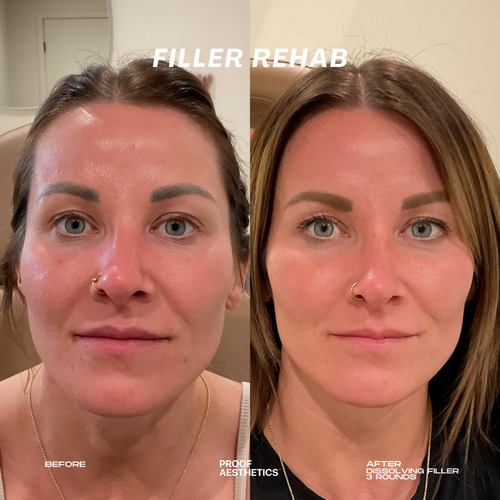 Filler Rehab