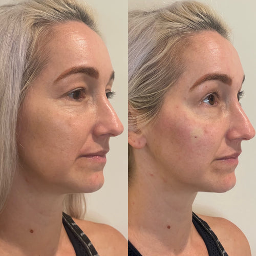 Should you get fillers? Here's how to tell according to Proof Aesthetics