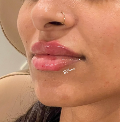 Full Syringe Lip Filler Proof Aesthetics 